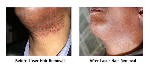 Laser Hair removal image 1