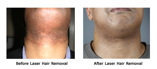 Hair Removal Image 2