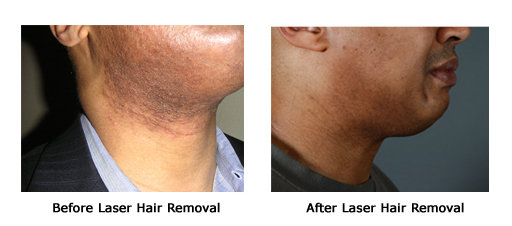 Laser Hair removal image 3