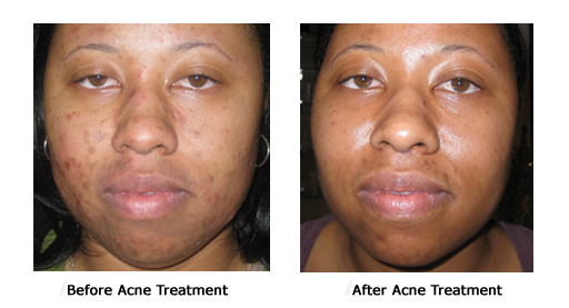 Acne1