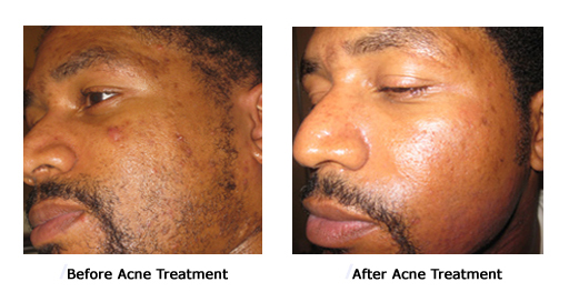 Acne3